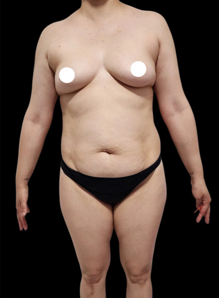 Resultado de abdominoplastia + lipoescultura hd – antes y después 21
