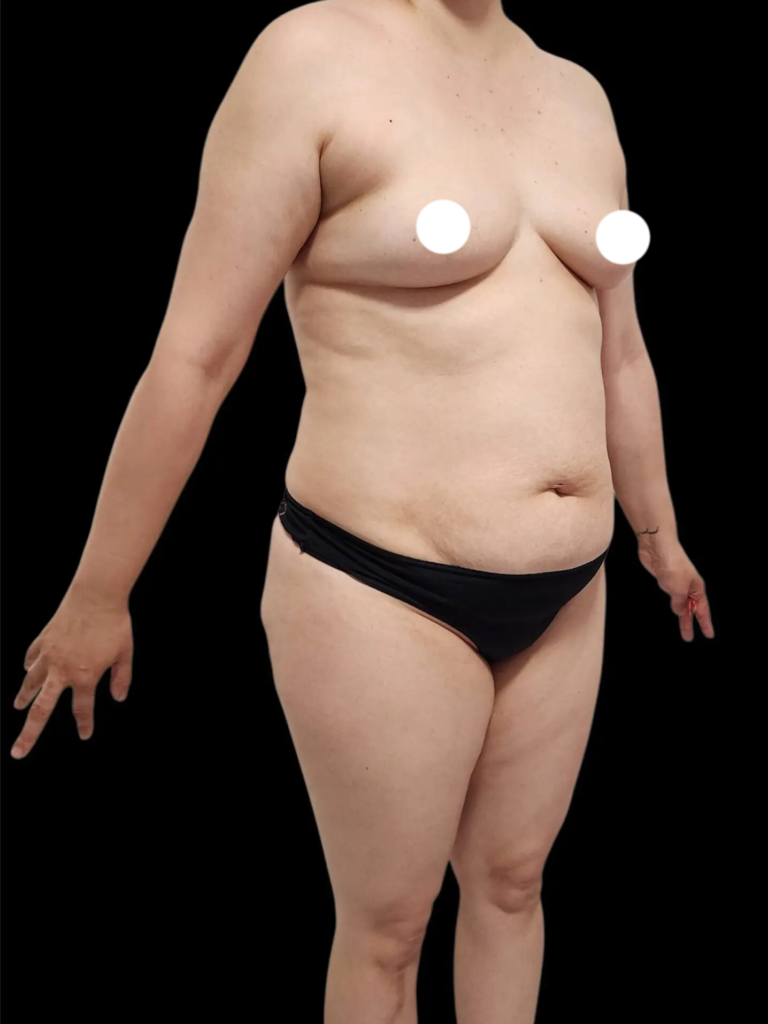 Resultado de abdominoplastia + lipoescultura hd – antes y después 23