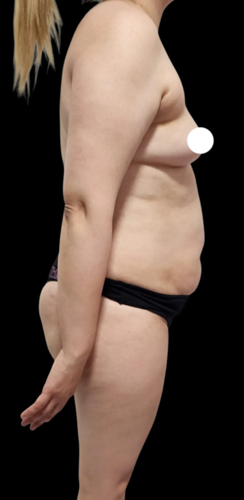 Resultado de abdominoplastia + lipoescultura hd – antes y después 25