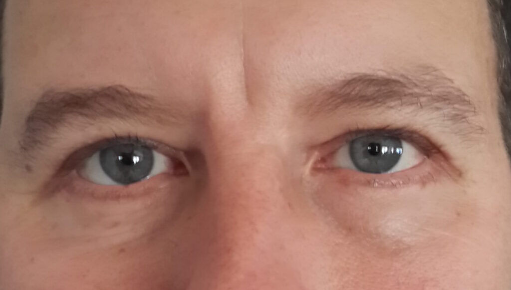 Resultado de blefaroplastia – antes y después 6