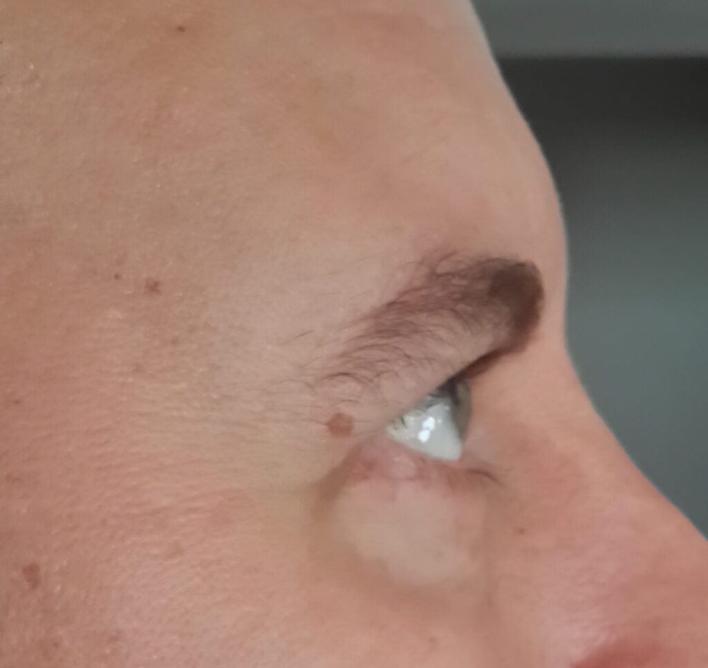 Resultado de blefaroplastia – antes y después 8