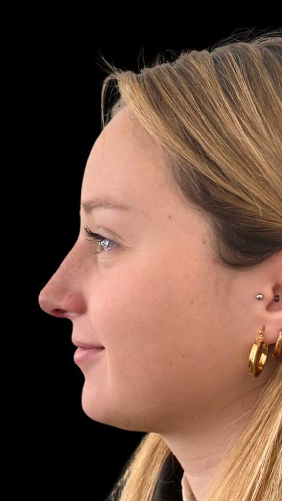 Resultado de rinoplastia ultrasónica estructurada – antes y después 25