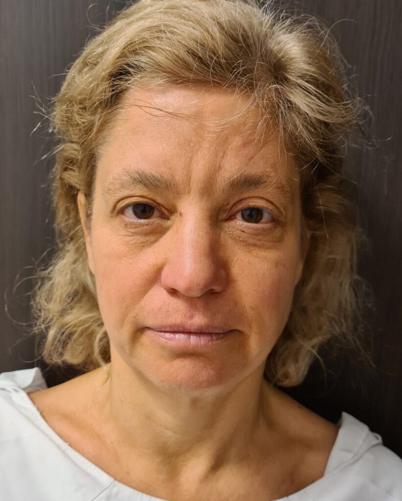 Resultado de lifting facial – antes y después 5
