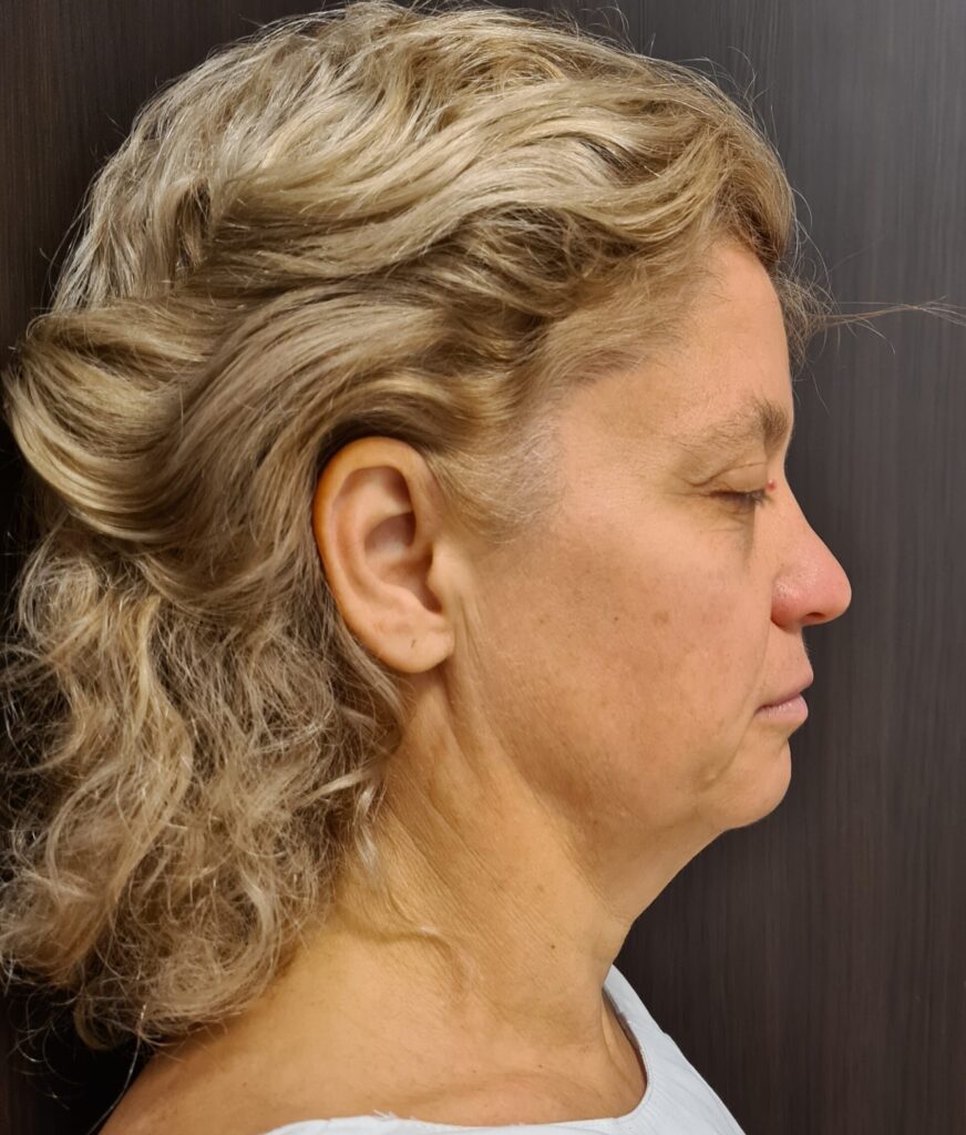Resultado de lifting facial – antes y después 7