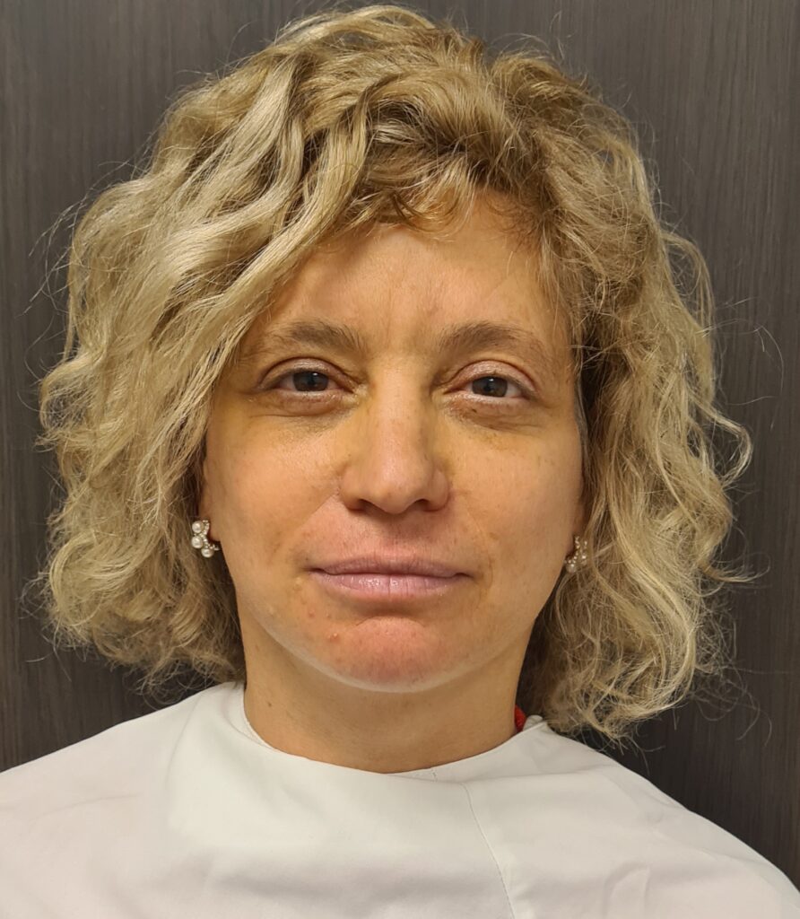 Resultado de lifting facial – antes y después 6