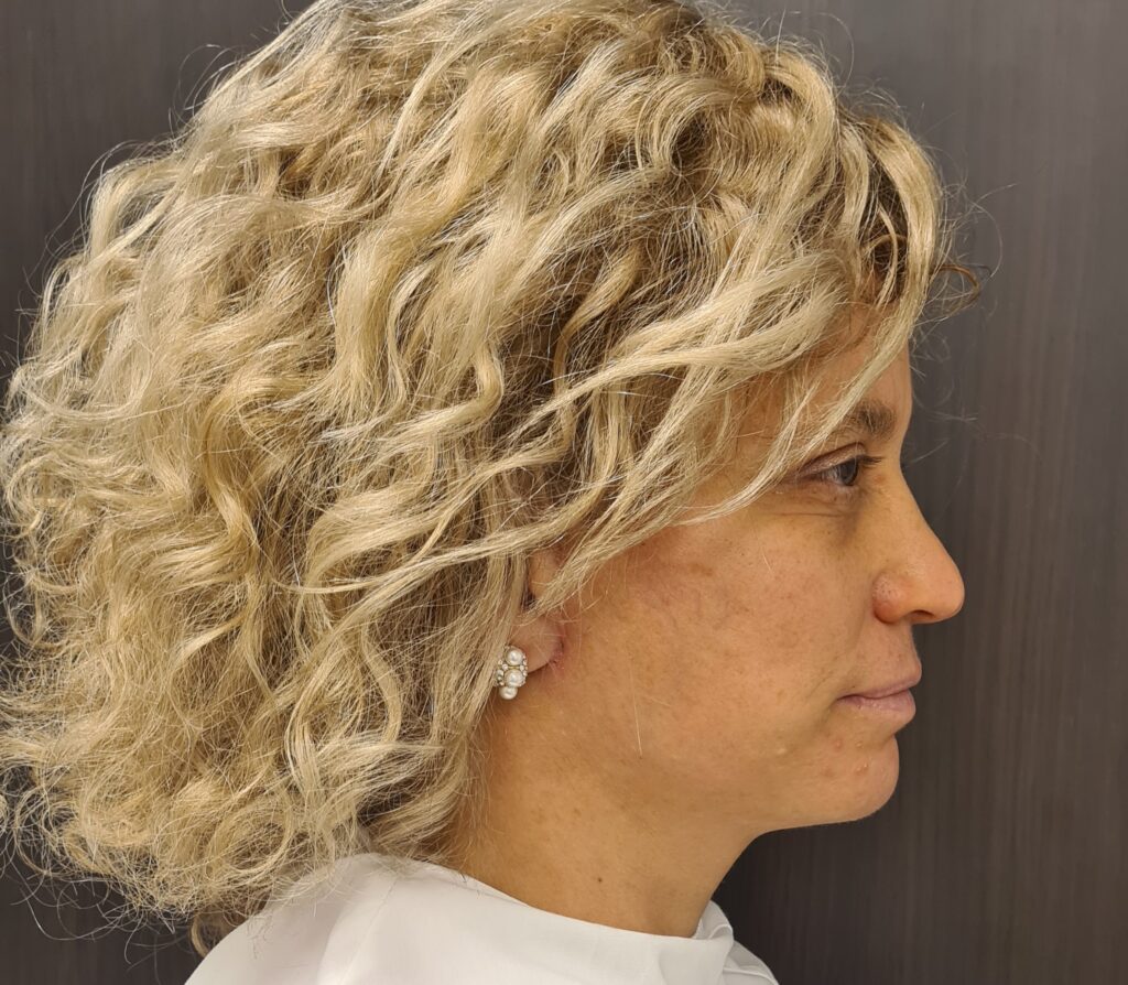 Resultado de lifting facial – antes y después 8
