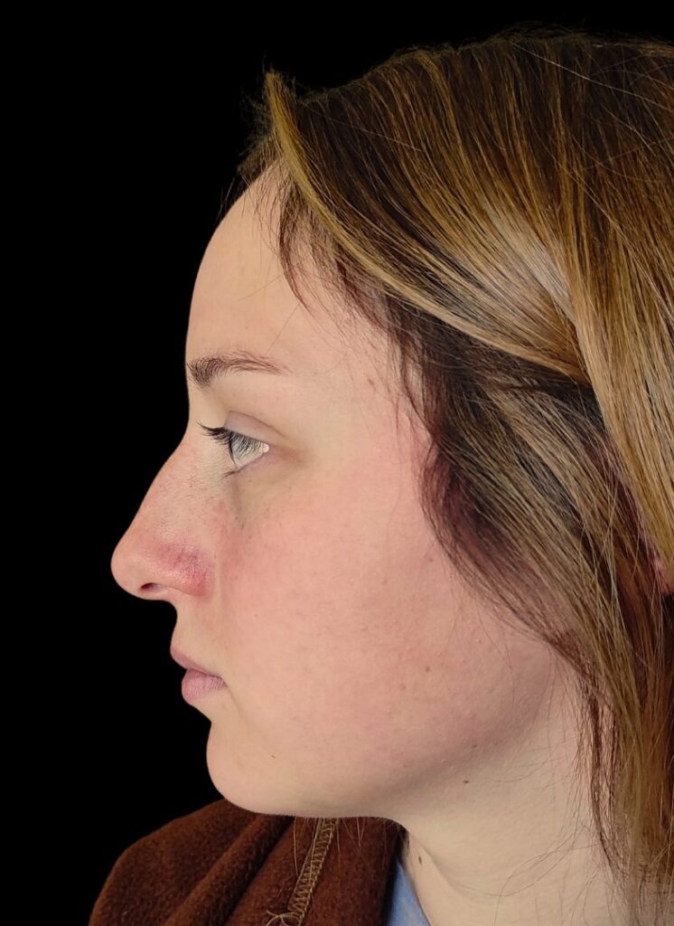 Resultado de rinoplastia ultrasónica estructurada – antes y después 26