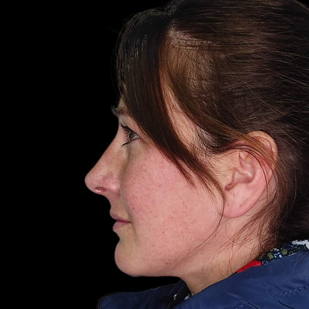 Resultado de rinoplastia ultrasónica estructurada – antes y después 30