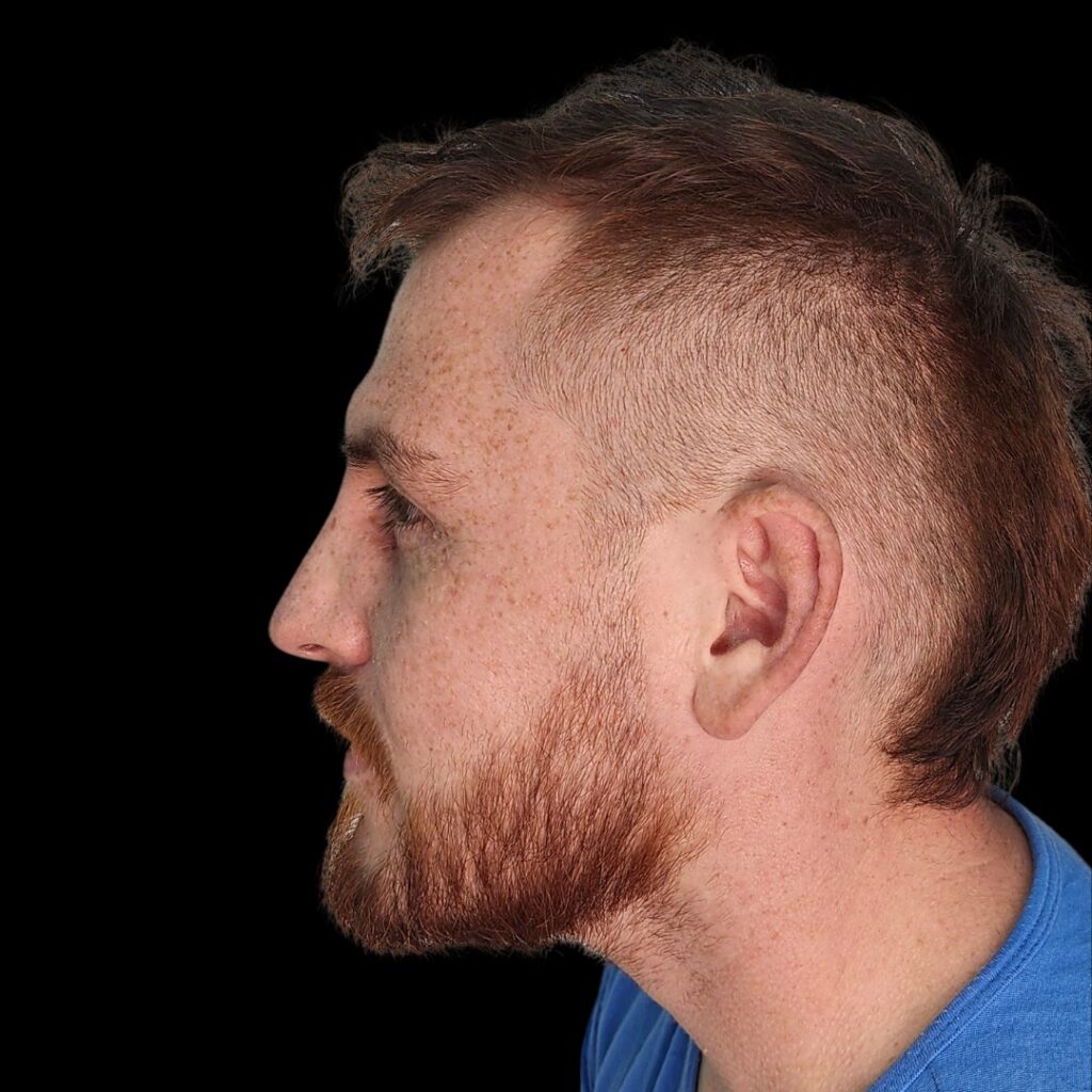 Resultado de rinoplastia ultrasónica estructurada – antes y después 24