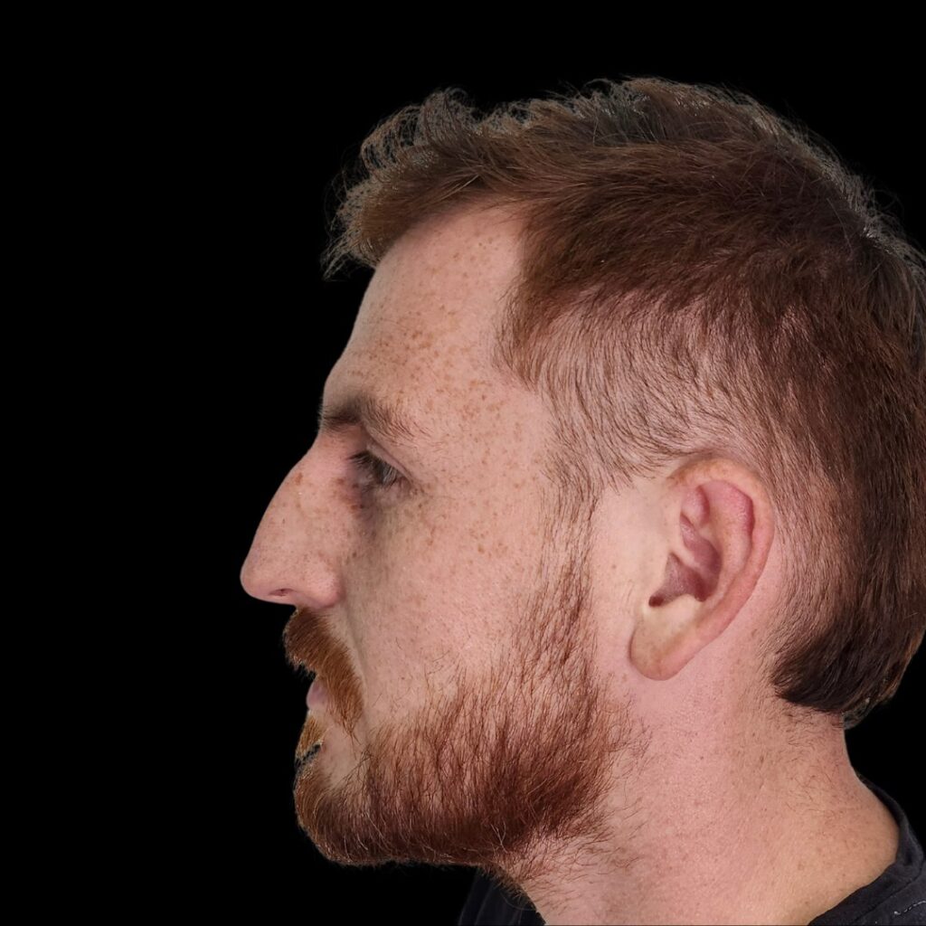 Resultado de rinoplastia ultrasónica estructurada – antes y después 23