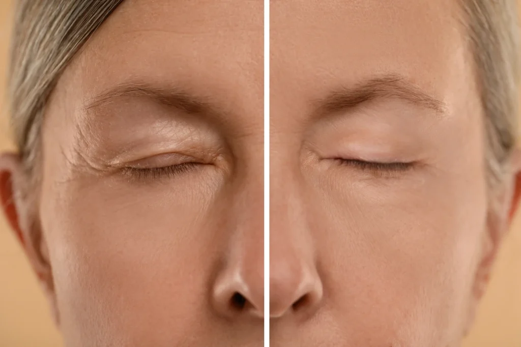 Blefaroplastia