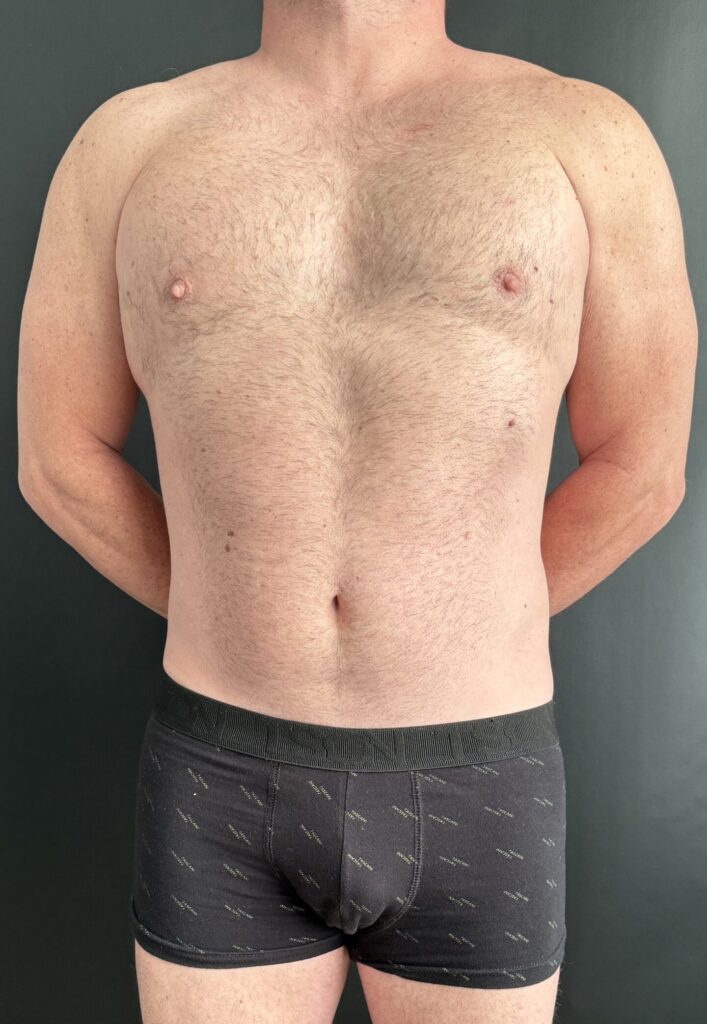 Resultado de lipoescultura hd femenina – antes y después 43