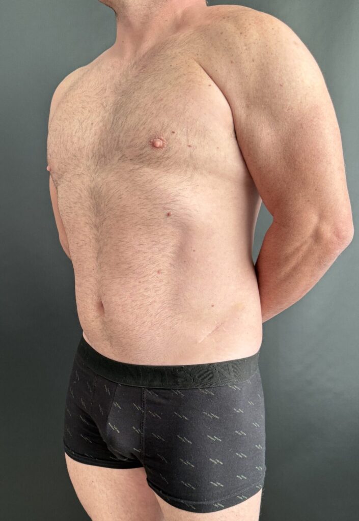 Resultado de lipoescultura hd femenina – antes y después 47