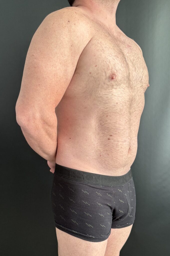 Resultado de lipoescultura hd femenina – antes y después 45