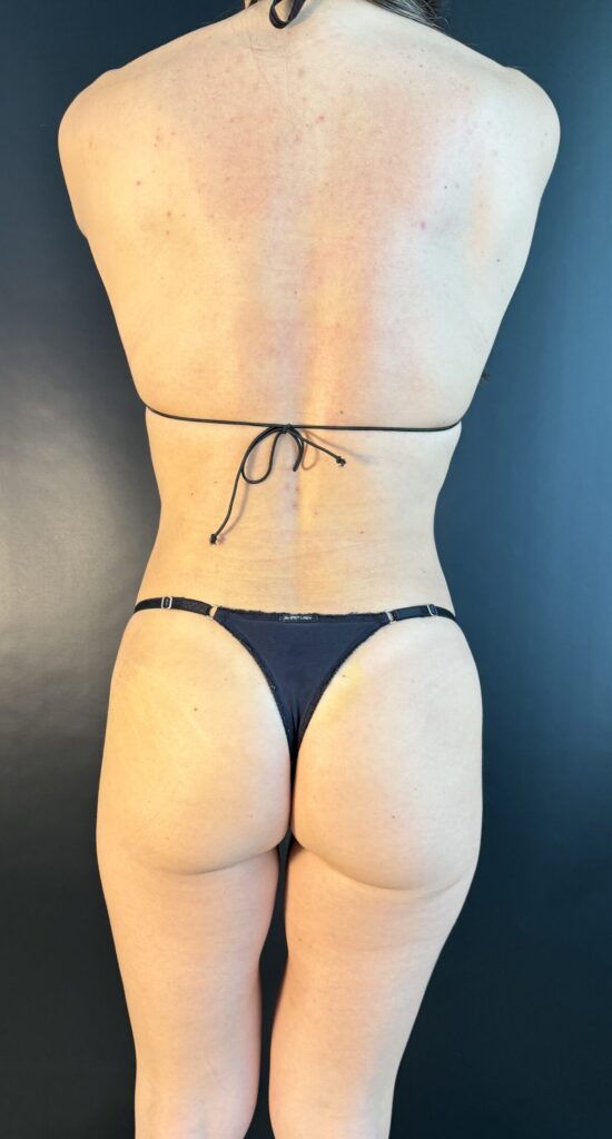 Resultado de lipoescultura hd femenina – antes y después 6