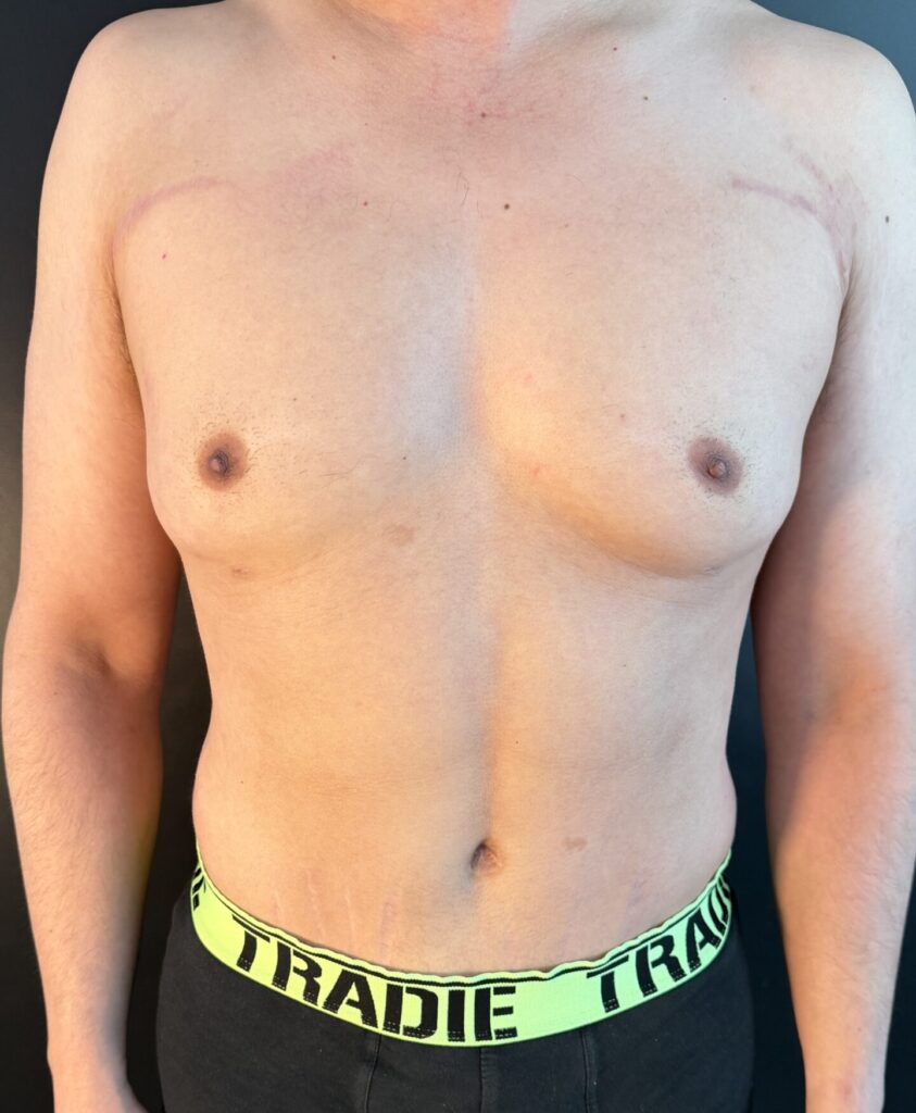 Resultado de abdominoplastia + lipoescultura hd – antes y después 28
