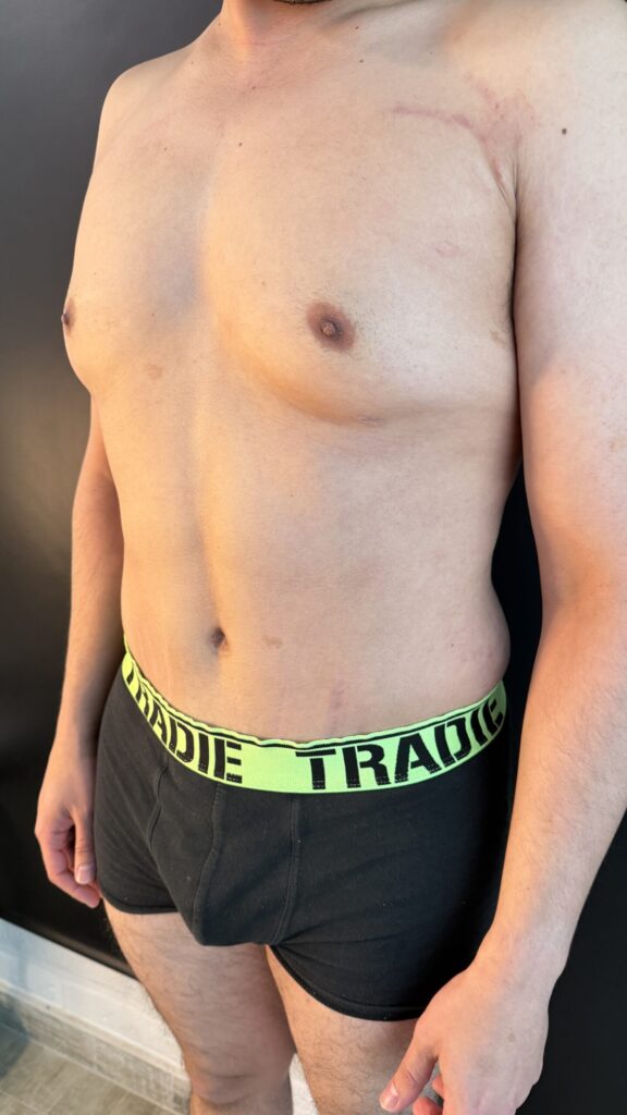 Resultado de abdominoplastia + lipoescultura hd – antes y después 30