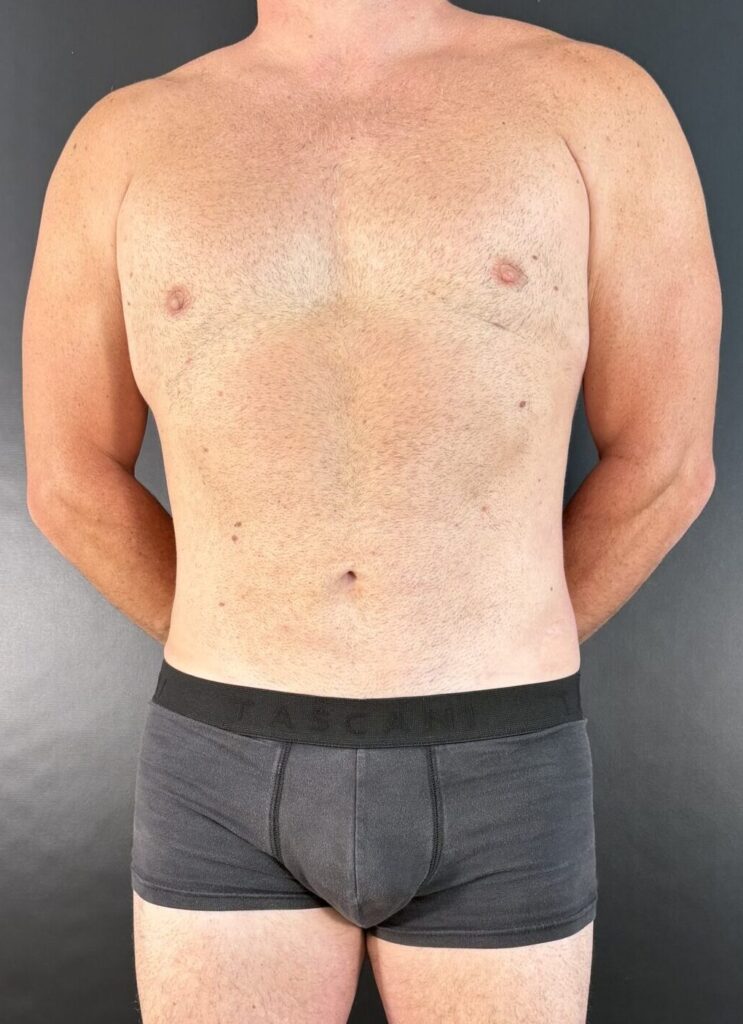 Resultado de lipoescultura hd femenina – antes y después 44