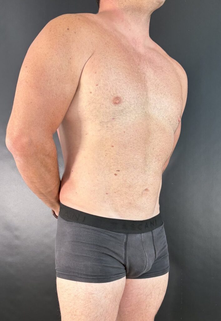 Resultado de lipoescultura hd femenina – antes y después 46
