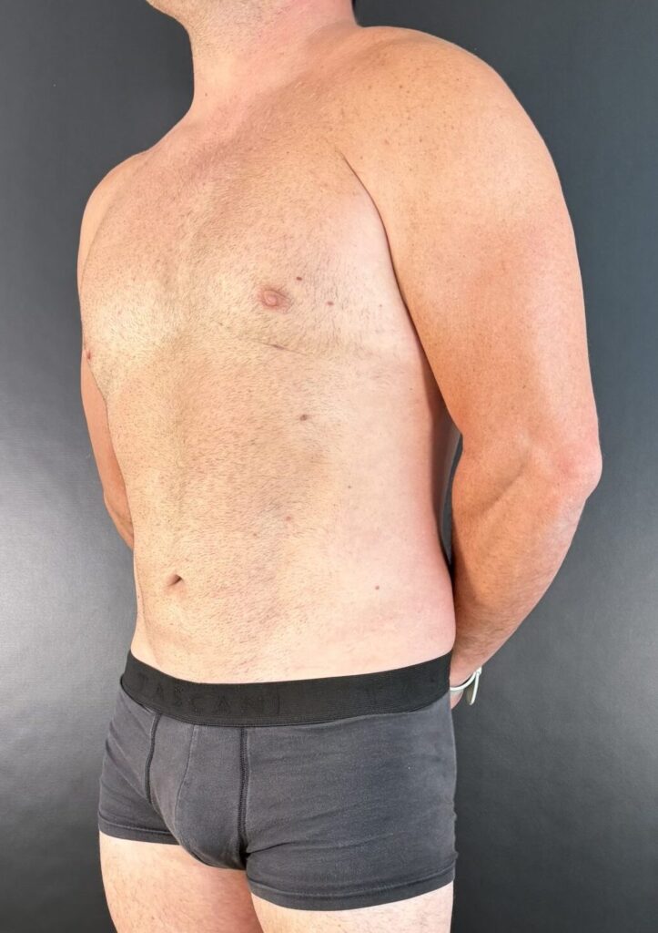 Resultado de lipoescultura hd femenina – antes y después 48
