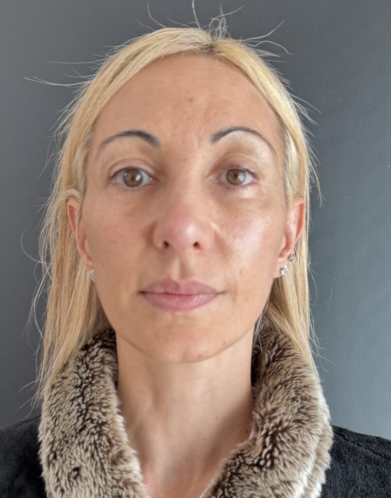 Resultado de lifting facial – antes y después 2