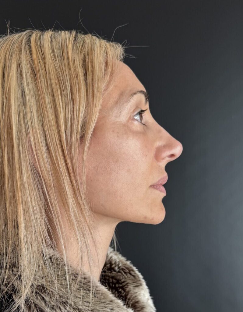 Resultado de lifting facial – antes y después 4