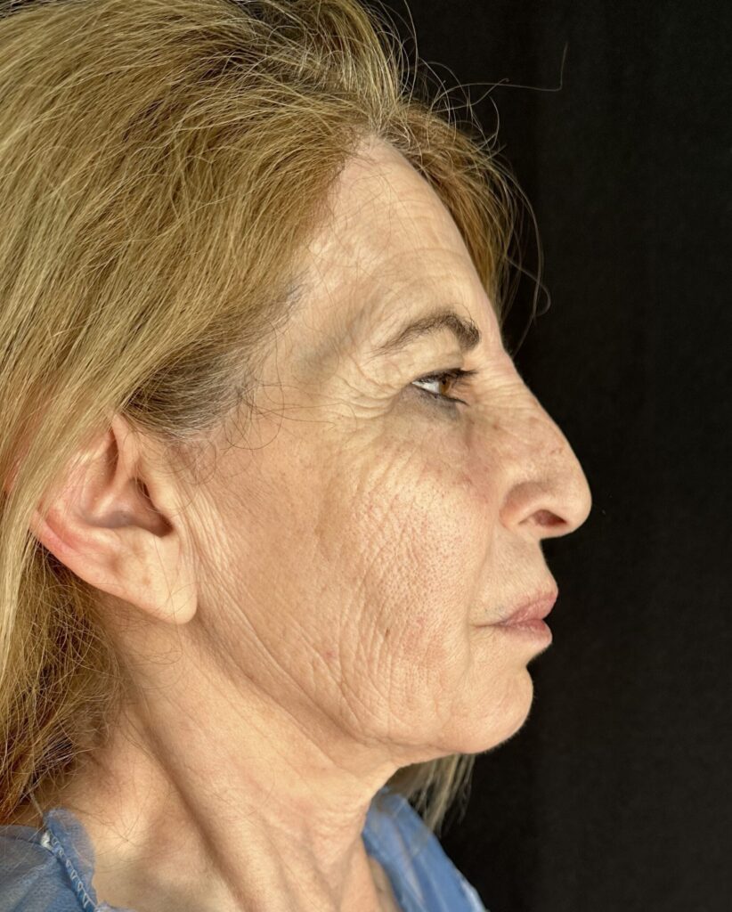 Resultado de rinoplastia ultrasónica estructurada – antes y después 21