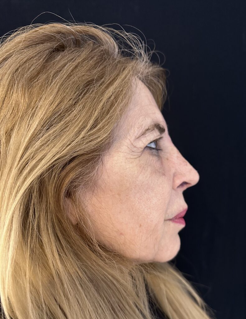 Resultado de rinoplastia ultrasónica estructurada – antes y después 22