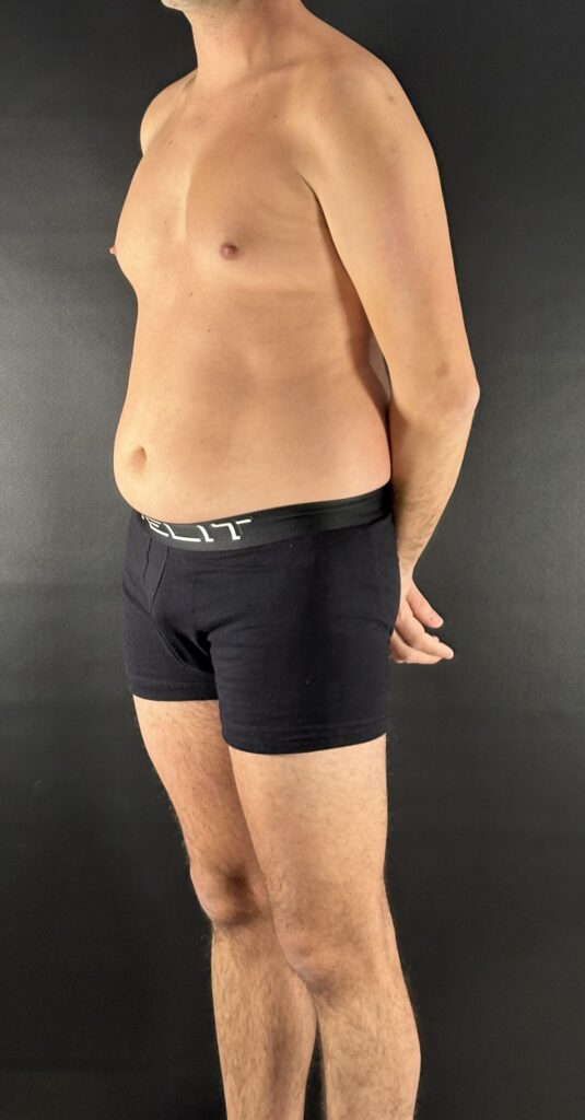 Resultado de lipoescultura hd masculina – antes y después 15