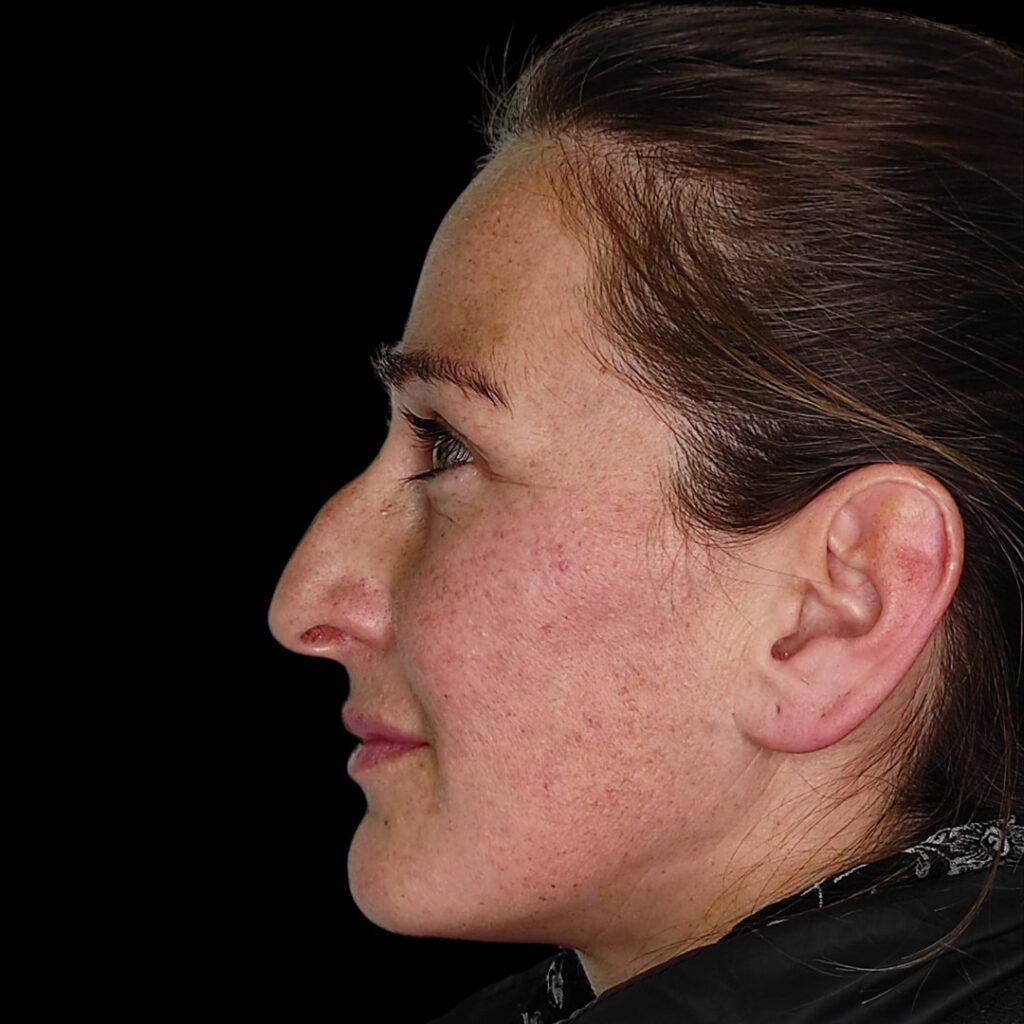 Resultado de rinoplastia ultrasónica estructurada – antes y después 9