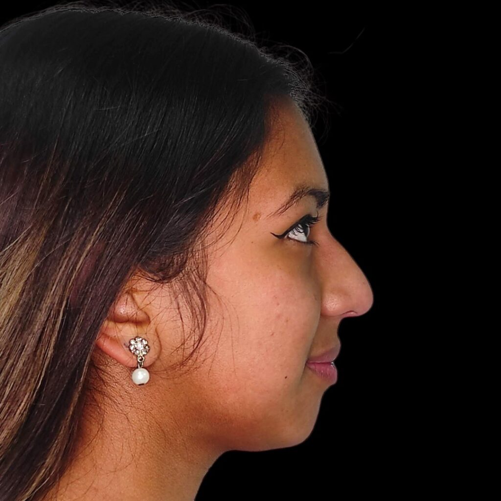 Resultado de rinoplastia ultrasónica estructurada – antes y después 11