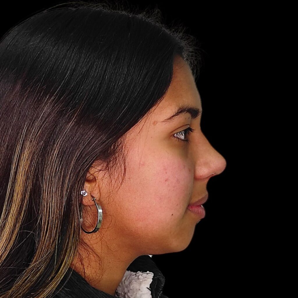 Resultado de rinoplastia ultrasónica estructurada – antes y después 12