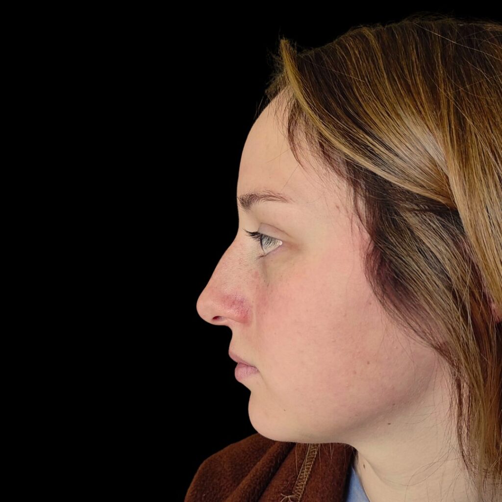 Resultado de rinoplastia ultrasónica estructurada – antes y después 13