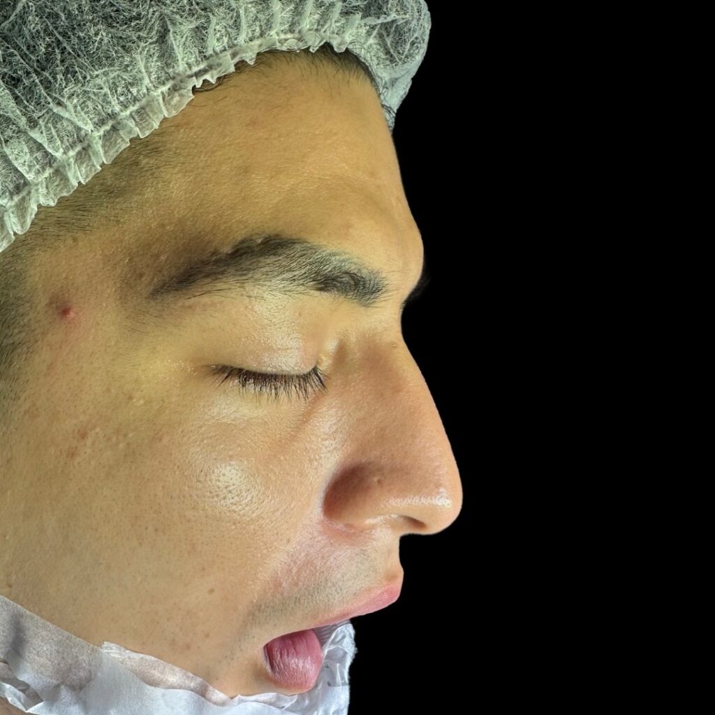Resultado de rinoplastia ultrasónica estructurada – antes y después 15