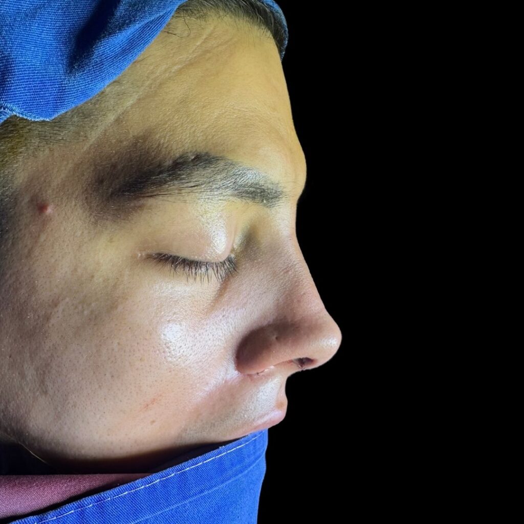 Resultado de rinoplastia ultrasónica estructurada – antes y después 16