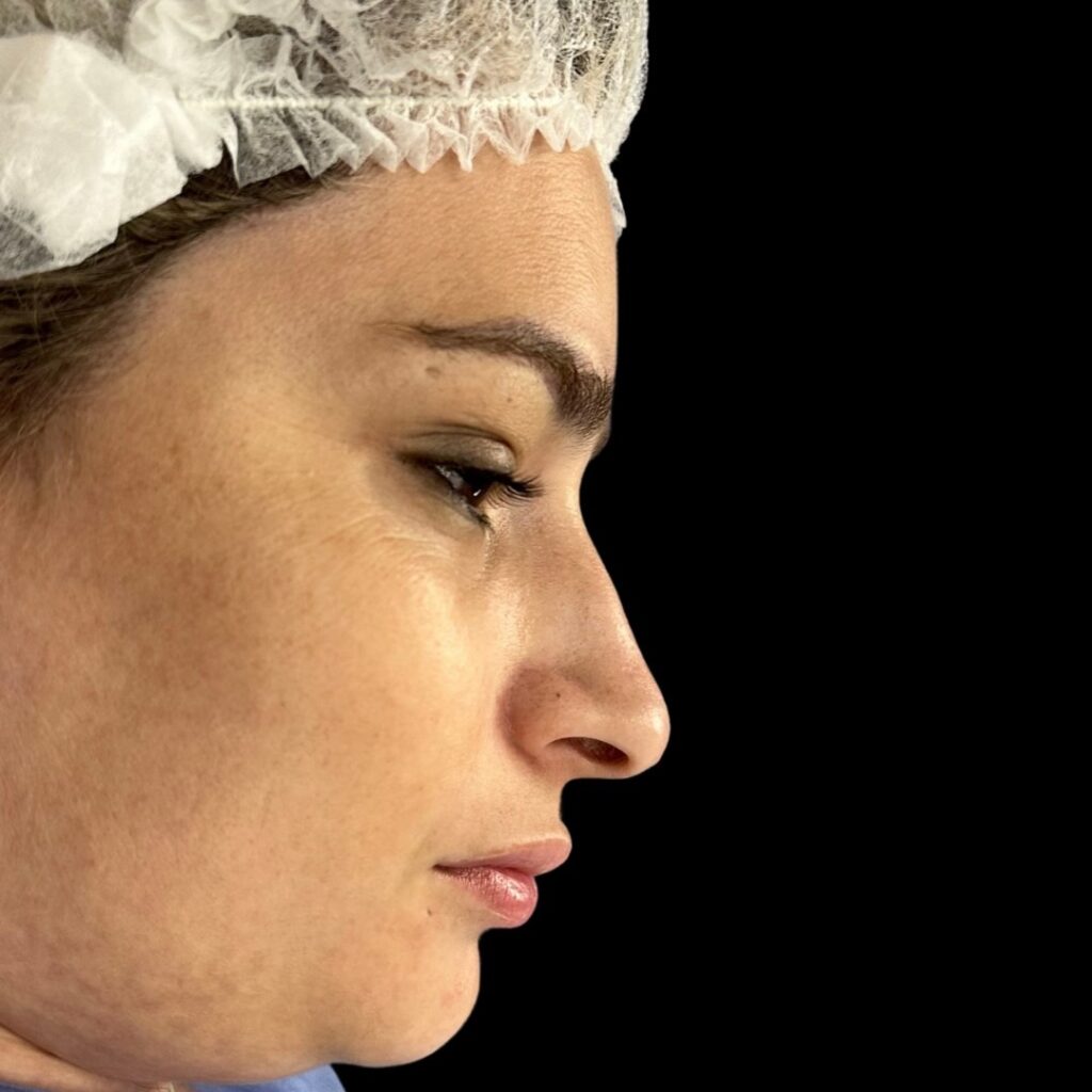 Resultado de rinoplastia ultrasónica estructurada – antes y después 17