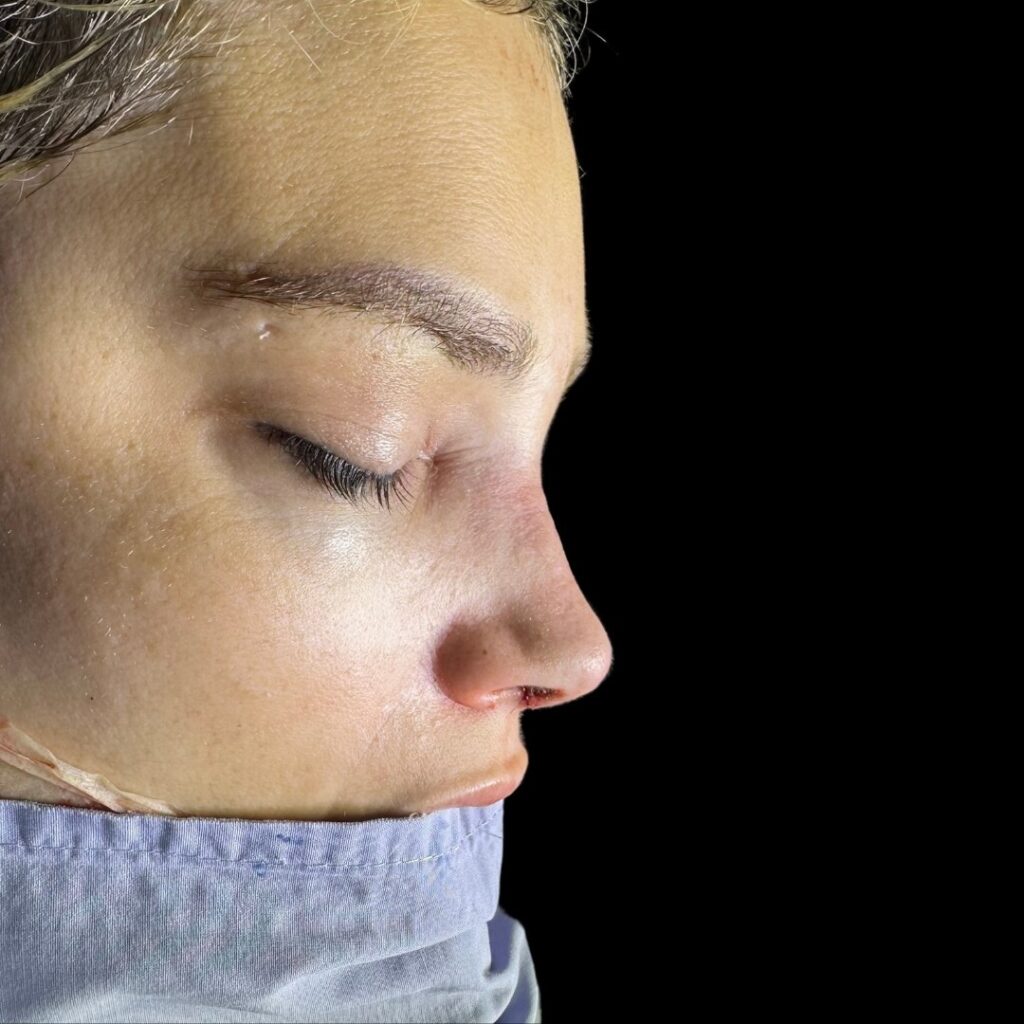 Resultado de rinoplastia ultrasónica estructurada – antes y después 18