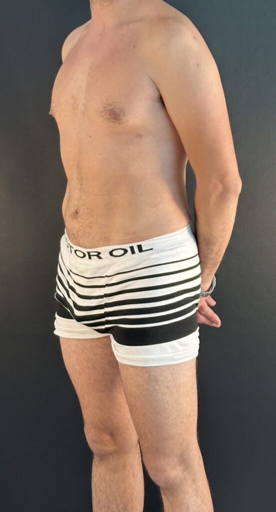 Resultado de lipoescultura hd masculina – antes y después 16