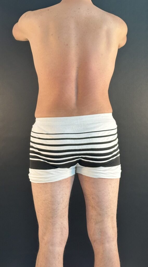 Resultado de lipoescultura hd femenina – antes y después 30
