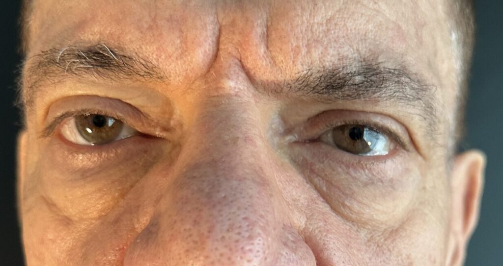 Resultado de blefaroplastia – antes y después 1