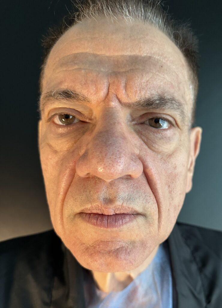Resultado de lifting facial – antes y después 9