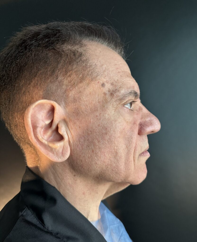 Resultado de blefaroplastia – antes y después 3