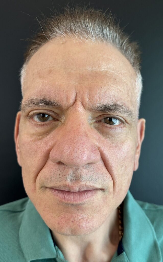 Resultado de lifting facial – antes y después 10