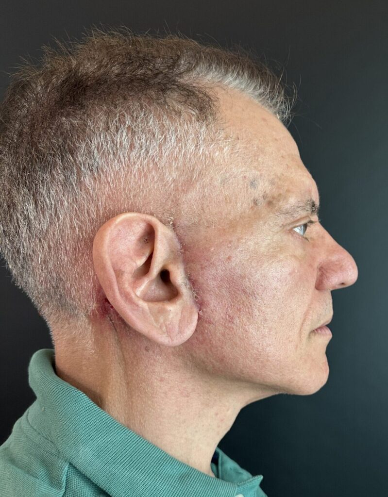 Resultado de lifting facial – antes y después 12