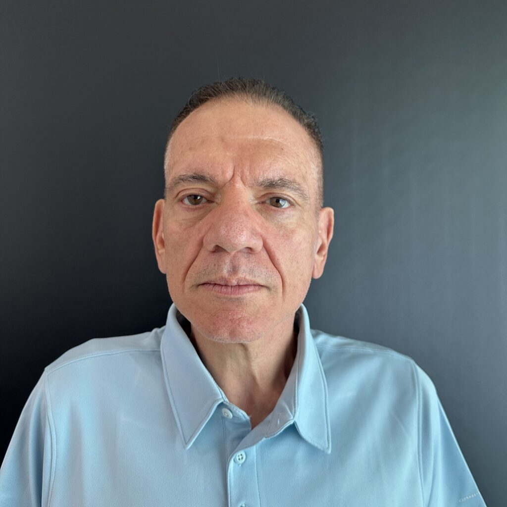 Resultado de blefaroplastia – antes y después 2