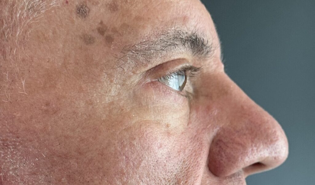 Resultado de blefaroplastia – antes y después 4