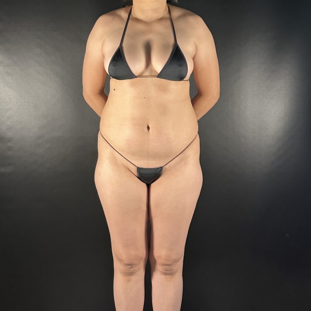 Resultado de lipoescultura hd femenina – antes y después 7