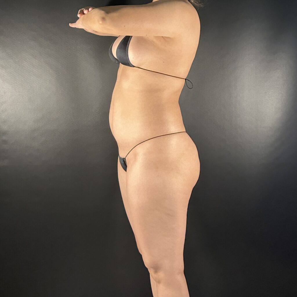 Resultado de lipoescultura hd femenina – antes y después 11