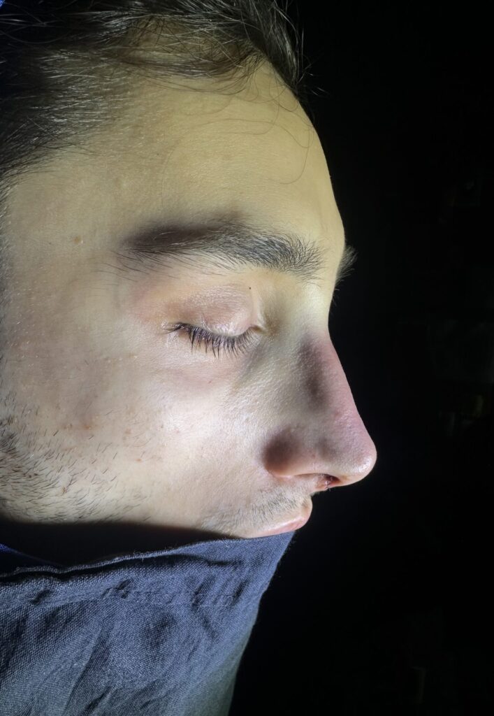 Resultado de rinoplastia ultrasónica estructurada – antes y después 19
