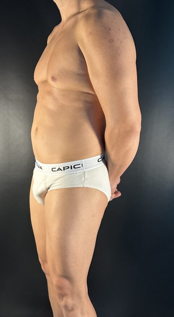 Resultado de lipoescultura hd masculina – antes y después 7
